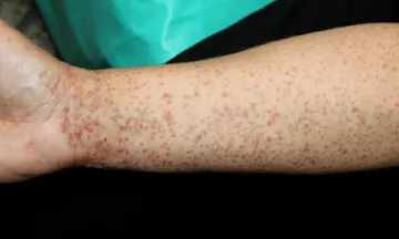 Lichen planus treatment