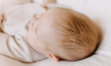 My babys head is full of yellowish