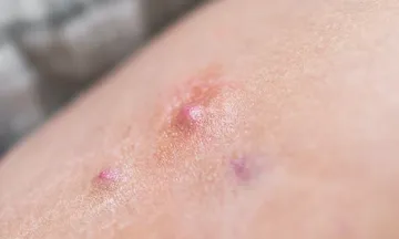 Painful Boils