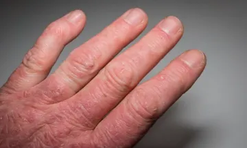 Remedies for Lichen Planus