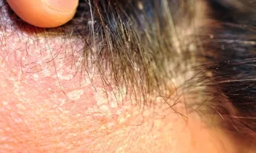 Seborrheic Dermatitis