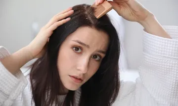 Seborrhoeic Dermatitis Treatment
