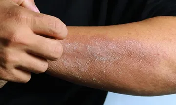Skin Infections