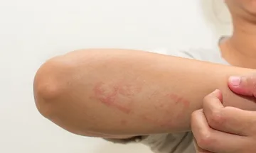 Symptoms of Lichen Planus