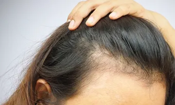 Thin Hair