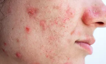Treat Acne Before Scarring