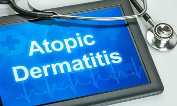 Treat atopic dermatitis