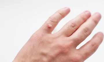 Warts