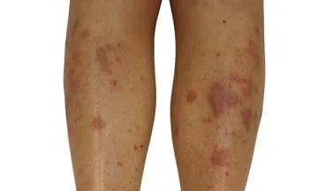 the onset of lichen planus