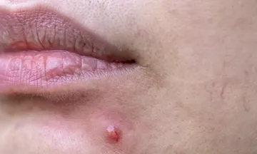acne scars