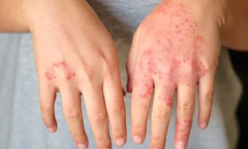 Allergic rhinitis