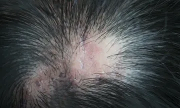 answering questions scalp lichen planus