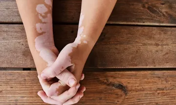 holistic approach for Vitiligo