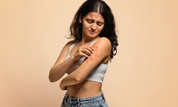 homeopathy atopic dermatitis