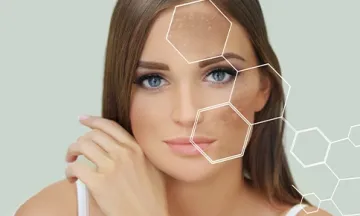 hyperpigmentation