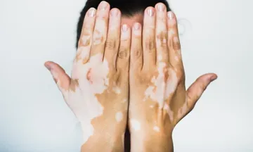 identify vitiligo