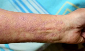 lichen planus classification
