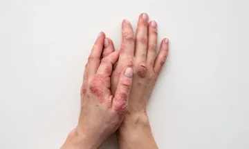 Psoriasis