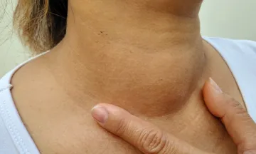 Swelling my neck