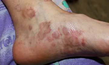 Treat lichen planus
