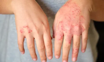 Psoriasis Getting Out of Control
