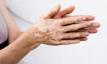 Vitiligo Treatment