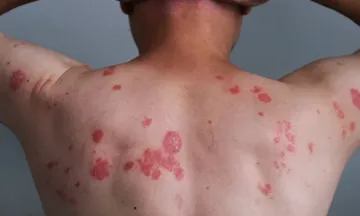 Guttate Psoriasis