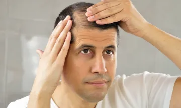 Hairline receding