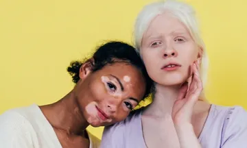 Vitiligo vs Albinism