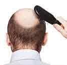 How to cure Male Pattern Baldness| Consult Dr Batra's™