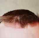 What I Wish Everyone Knew About Scalp Psoriasis And Homeopathy.