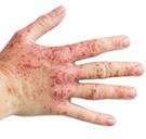 What are the 7 different types of Eczema?