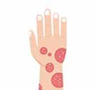 Psoriasis Or Eczema - What’s The Difference?