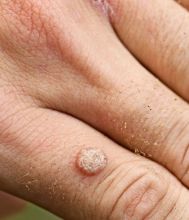 Get rid of warts with homeopathy