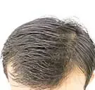 Can homeopathy help your hair grow back after thinning?