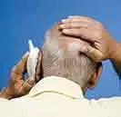 Losing hair due to Alopecia- Treat it with Homeopathy