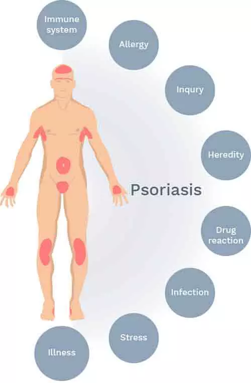 Symptoms of Psoriasis