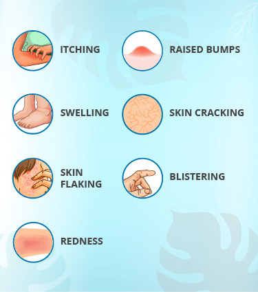Symptoms of Skin Allergy