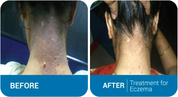 Laser Hair Removal Successful Tips in Singapore