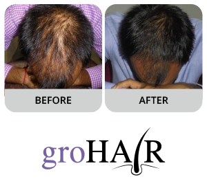 Hair Evaluation Test - Gro Hair - New Hair