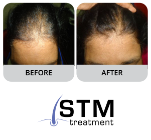 Hair Evaluation Test - Before and After - STM Treatment