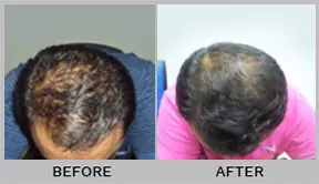 Dr Batra's® Hair Fall Treatment