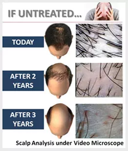 Homeopathy Hair loss Treatment