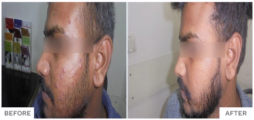 Hair Fall Treatment