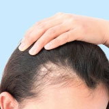 Female Pattern Baldness Symptoms