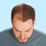 Hair Loss Treatment