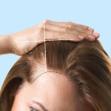 Hair Loss Treatment Result