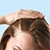 Hair Loss causes