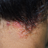 Seborrheic Dermatitis treatment