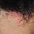 seborrheic dermatitis